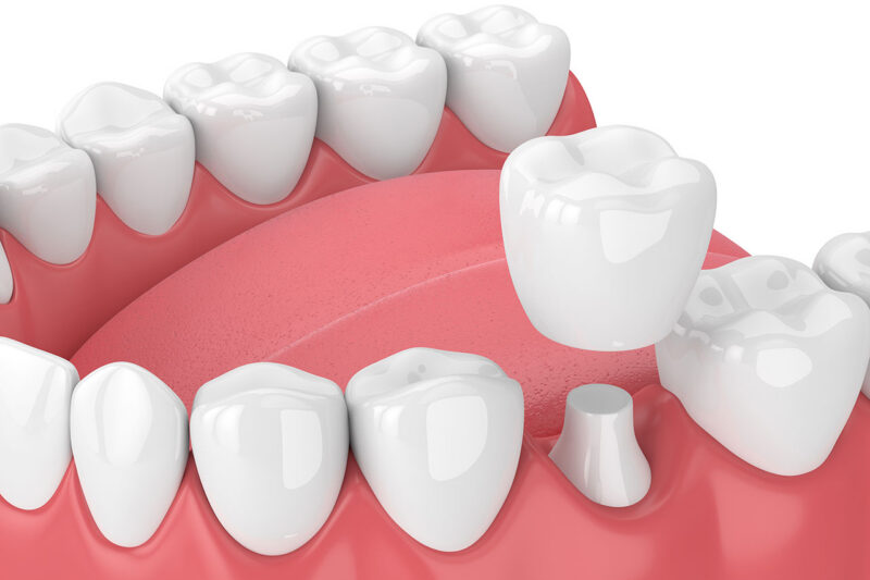 Same Day Crowns in Scottsdale: Can You Really Get a Dental Crown in One Visit?