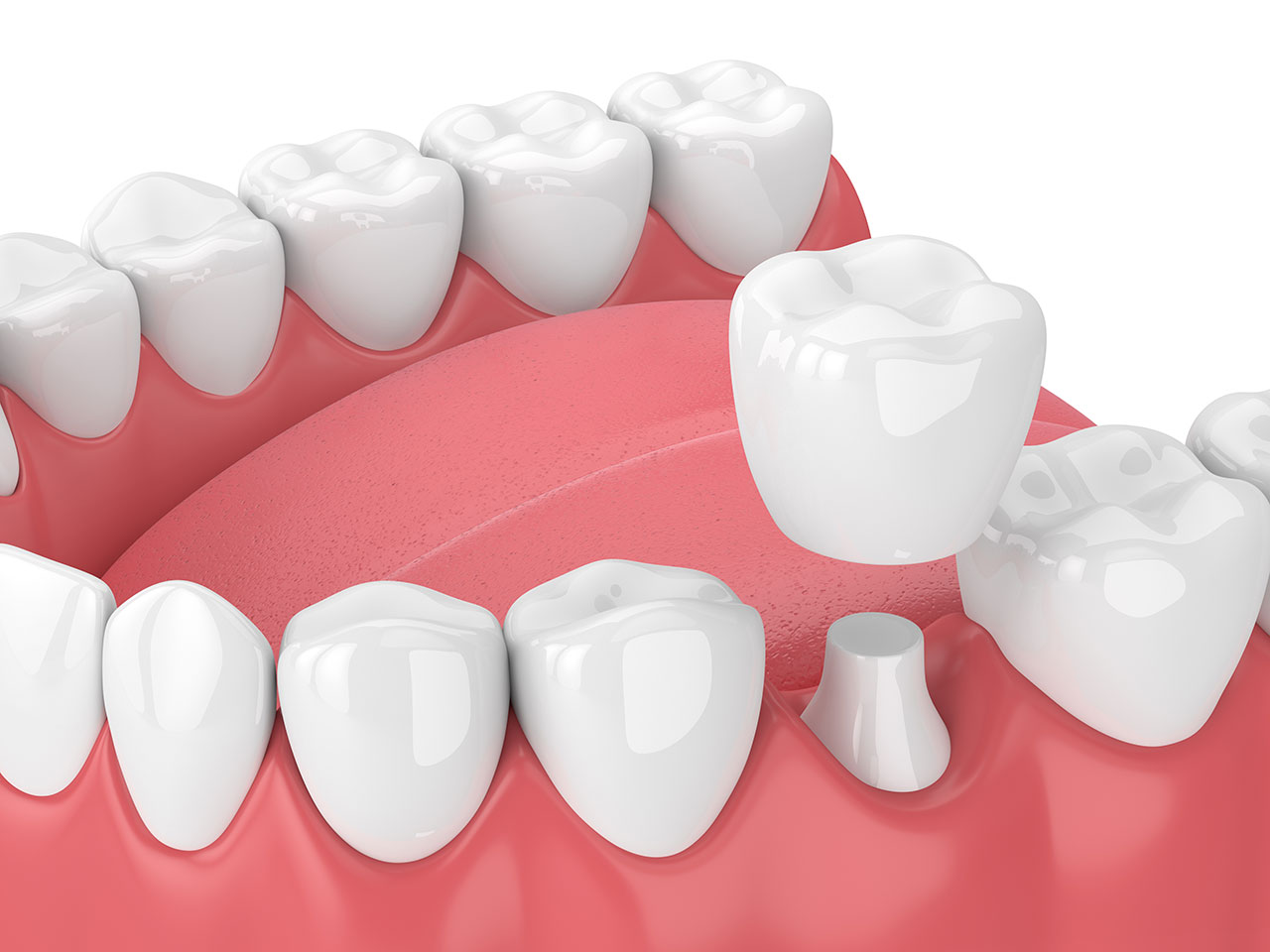 Same Day Crowns in Scottsdale: Can You Really Get a Dental Crown in One Visit?